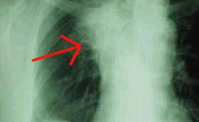 Жизнь с фиброзом лёгких