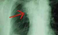 Жизнь с фиброзом лёгких - Полезные советы